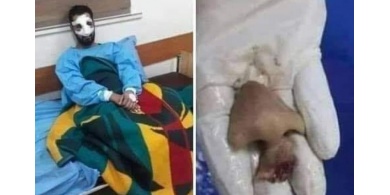نابلس : هل قامت زوجة بقضم أنف زوجها بسبب علاقته بفتيات ؟