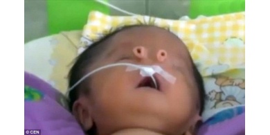 صور| ولادة طفل بأنبوبين في وجهه عوضاً عن الأنف