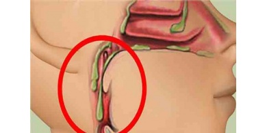 تجنبوا هذه الأطعمة الأربعة للتخلص من البلغم في الحنجرة