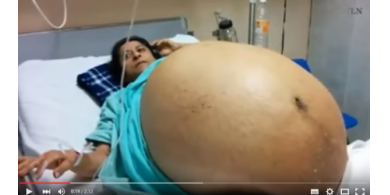 إمرأة تزن أكثر من 275 كيلو.. شاهد ماذا وجدوا داخل جسمها! .. فيديو