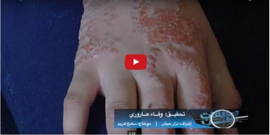 بالفيديو: الخضاب الحارق.. تحقيق استقصائي يكشف لغز الحناء المسببة لأمراض جلدية في أسواقنا !