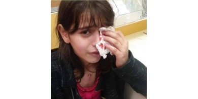 إصابة طفلة بعينها في هجوم للمستوطنين بالقدس المحتلة