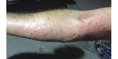 اصابة شاب من كفر قدوم بانفجار جسم مشبوه