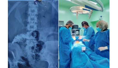 جراحة استثنائية....214 إبرة ودبوسا في بطن رجل