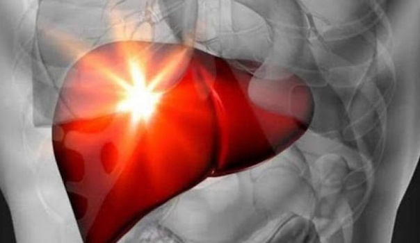 علماء يابانيون يبتكرون علاجاً لتليف الكبد