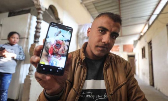 غزة.. قنبلة إسرائيلية تُفقد فلسطينيا فمه وأحلامه