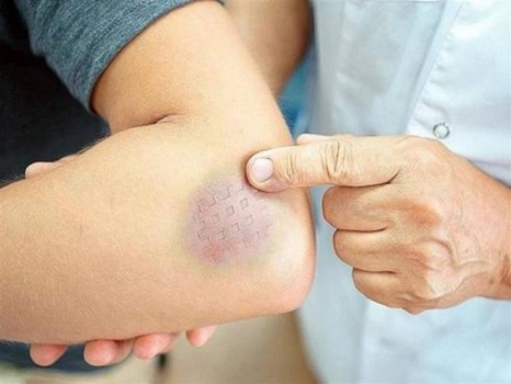 إذا ظهرت كدمات مجهولة على جسمك.. قد تدل على 7 مشاكل صحية