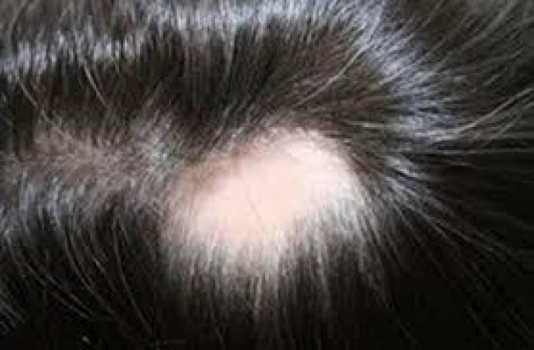 علاج الثعلبة عند الأطفال