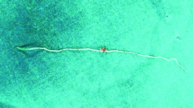 دودة بطول 12 سم في خد امرأة