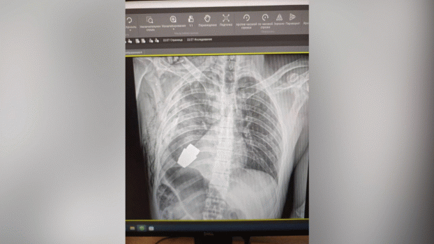 بحضور خبيري متفجرات .. إزالة قنبلة يدوية من صدر جندي أوكراني