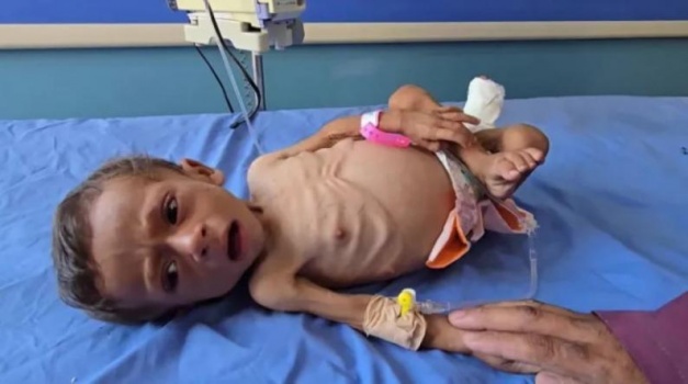 في أعلى حصيلة منذ أشهر: شهداء سوء التغذية في غزة يرتفع إلى 185 خلال أغسطس