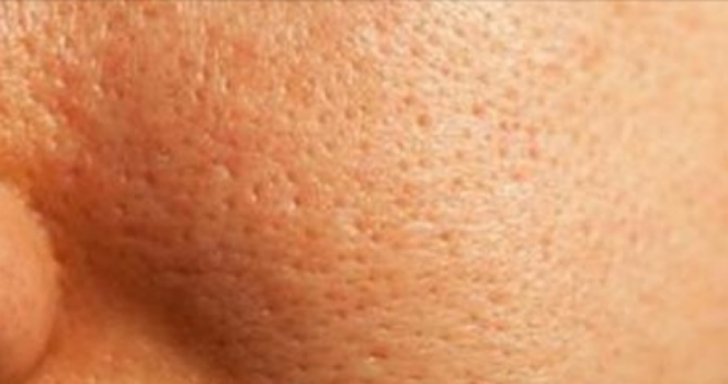 تخلص من المسام المفتوحة بعد إزالة شعر الوجه!