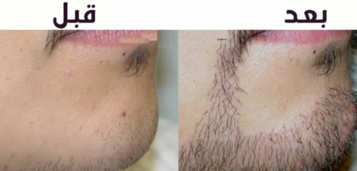 إليكم طرق زيادة شعر اللحية عند الرجال!