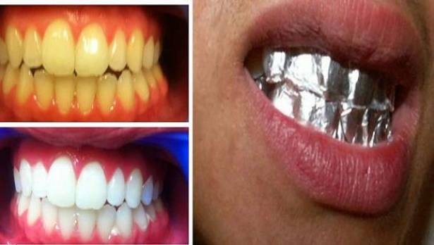 لأسنان ناصعة البياض خلال ساعة واحدة .. استخدموا “ورق الألمنيوم”!!