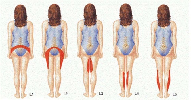 "عرق النسا".. ما هي أعراضه وأسبابه وطريقة علاجه؟!