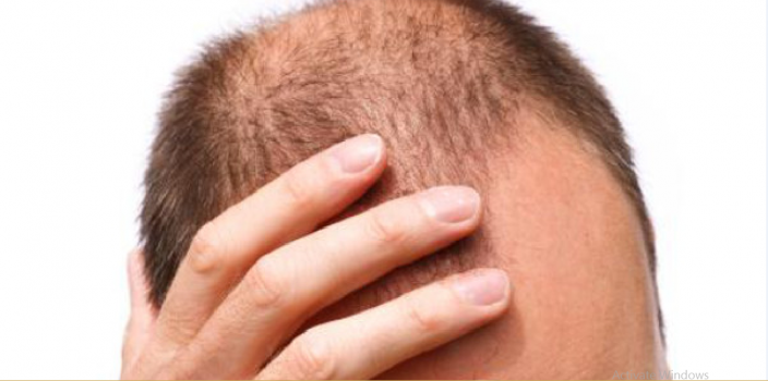 ماذا يحدث للأصلع بعد زراعة الشعر؟