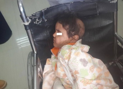 رأس محروق وأسنان محطمة قصة طفلة نجت من «سلخانة تعذيب»