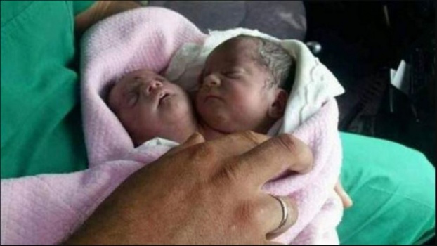 في حالة فريدة.. ولادة طفل برأسين في إدلب!