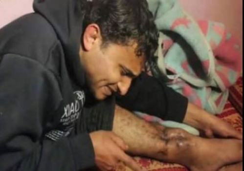 المشوخي بعد تهديد الاطباء بقطع رجله وصل عمان وتناول وجبة “منسف بمبادرة من اهالي المخيمات