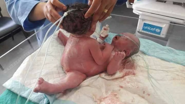 ولادة نادرة لتوأم سيامي في غزة