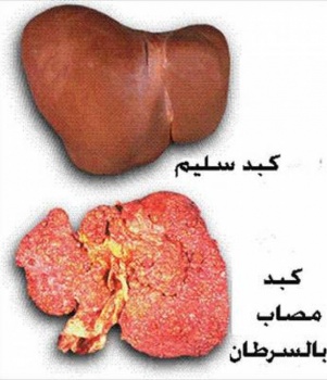 المالتون آخر إختراع لضرب السرطان
