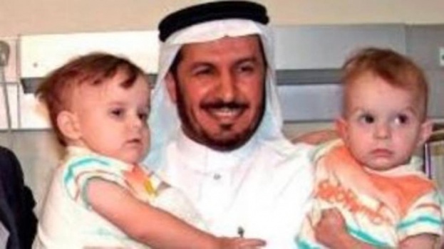 شاهد كيف أصبح التوأم السيامي البولندي بعد 15 عاماً من فصلهما