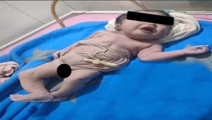 حالة نادرة... وفاة طفل بعد ولادته بدون بطن جنوب مصر (صورة)
