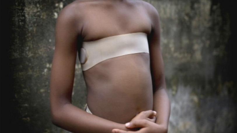 18_breast_w